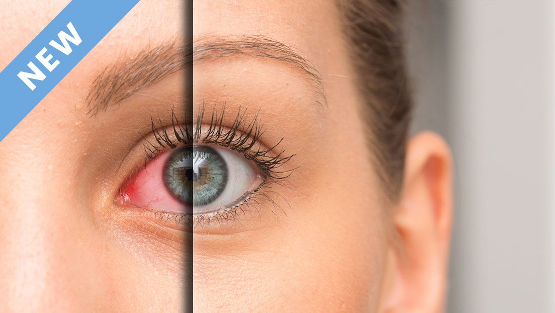Amniotic Membrane Therapy